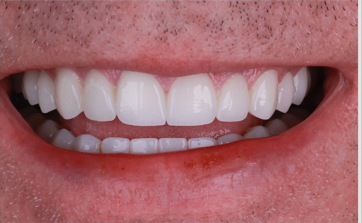Efter – Hollywood Smile i zirkonia
