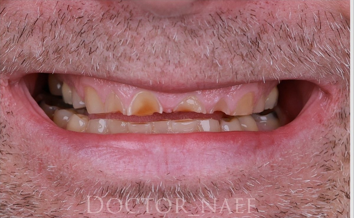 Före – Hollywood Smile i zirkonia