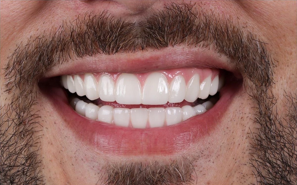 Efter – Hollywood Smile i zirkonia