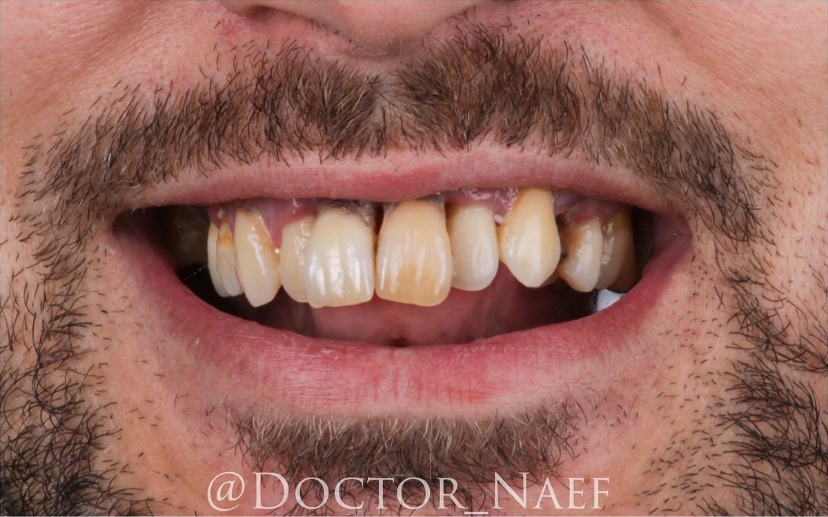 Före – Hollywood Smile i zirkonia