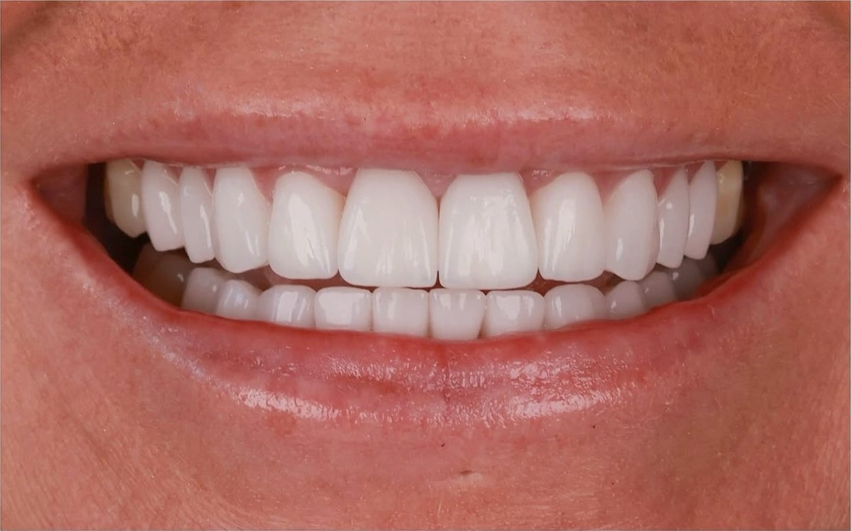 Efter – Hollywood Smile i zirkonia