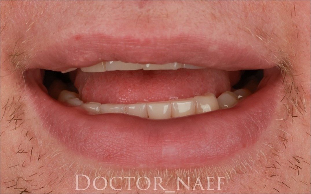 Före – Hollywood Smile i zirkonia